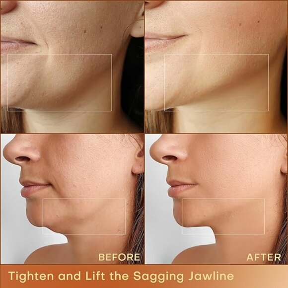 MLAY RF01 Radio Frequency (RF Technology) Skin Tightening Beauty Instrument - Picture 6 of 16